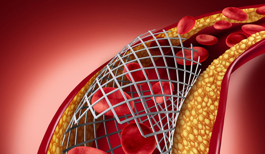 Treatment and Management of a Heart Attack